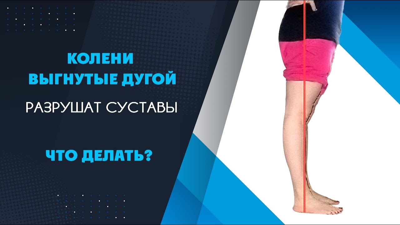 Что делать при рекурвации коленей? Колени выгибаются назад. Опасно ли это?