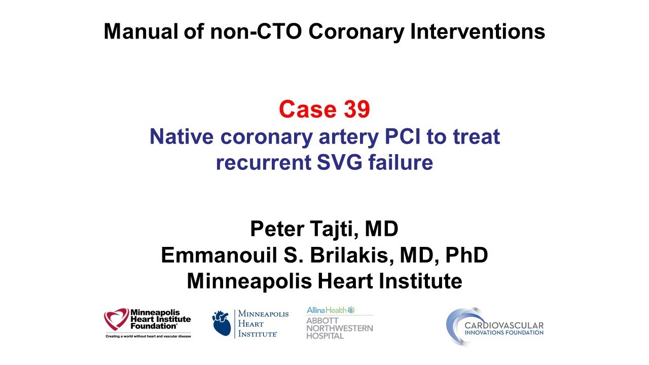 Case 39: PCI Manual - Native instead of SVG PCI