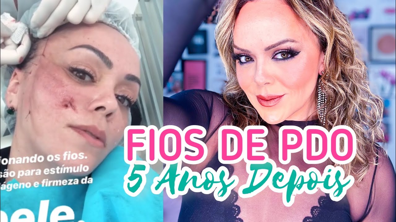 Fios de PDO - 5 anos depois