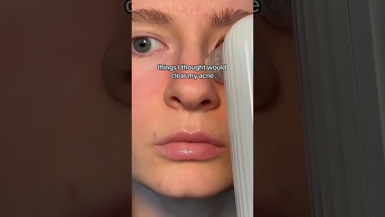 Things I thought would clear my acne ￼😭 #acne #skincare #beauty #skincareroutine #acnetreatment