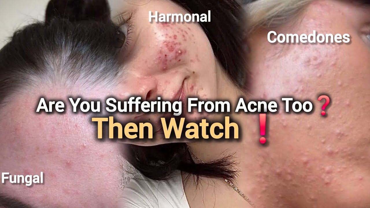 How to  Treat Acne  at Home   |  "Treatment of  Acne | Best Skincare for Acne Prone Skin✨️