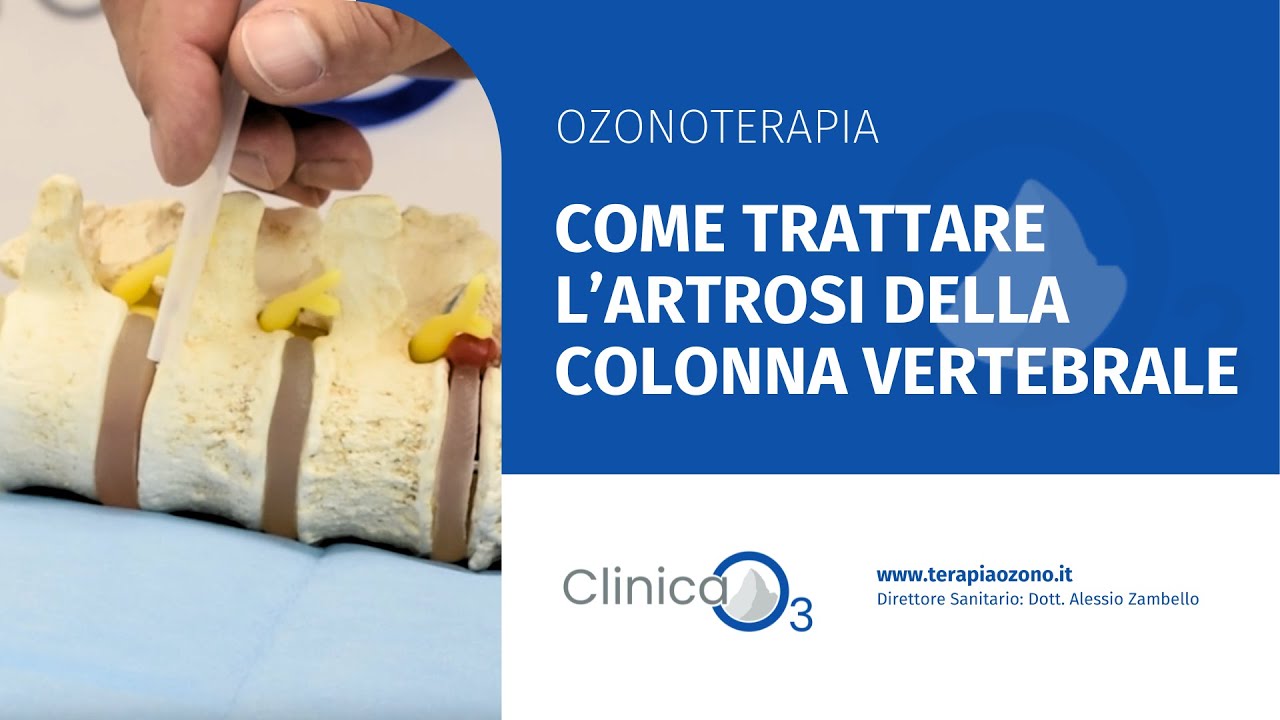Come trattare l&rsquo;artrosi della colonna vertebrale