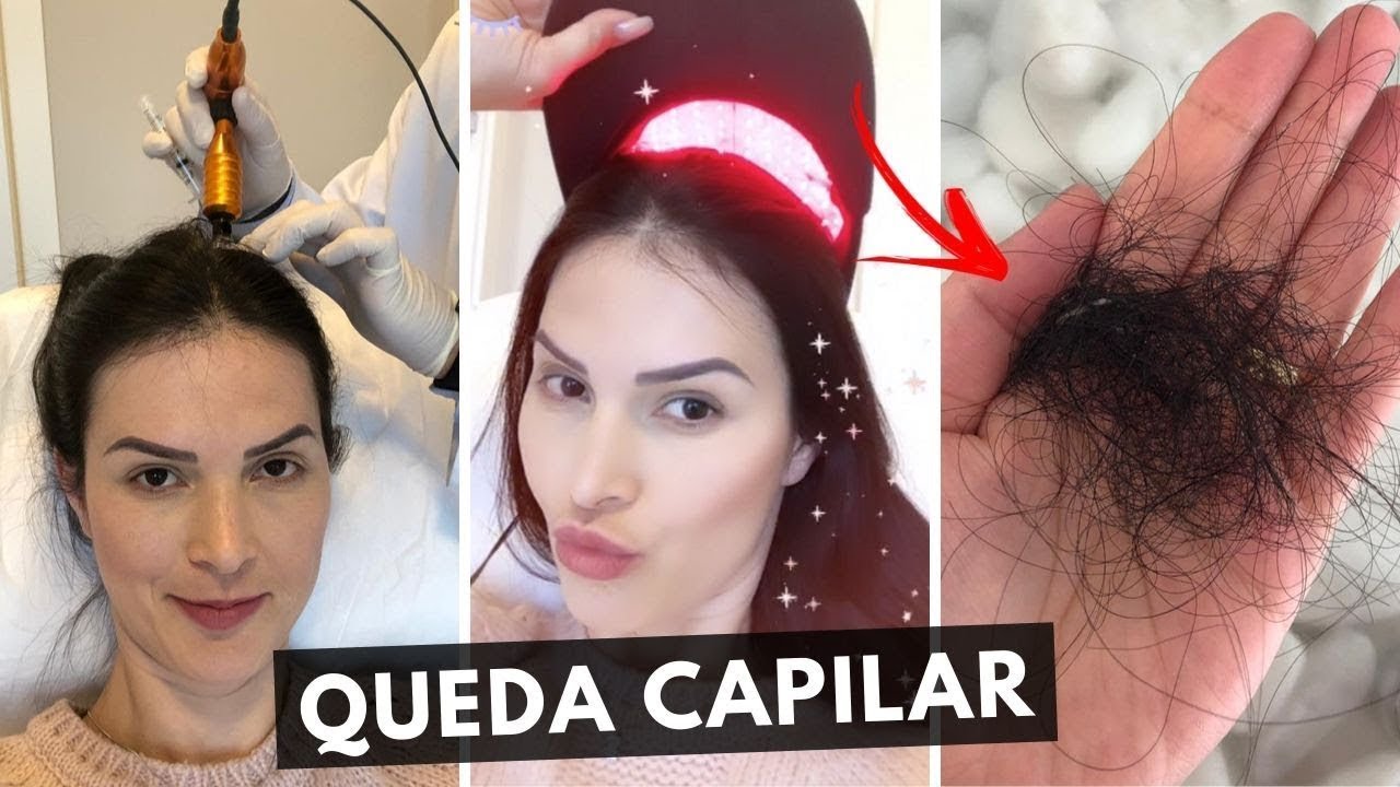 EFLÚVIO TELÓGENO - TRATAMENTO, RECUPERAÇÃO, TEM CURA, DEIXA CARECA? QUEDA CAPILAR, MINOXIDIL