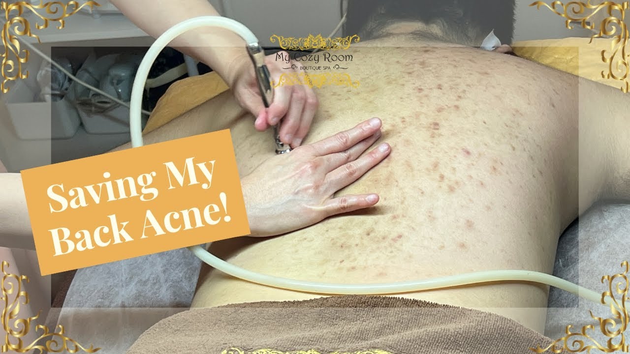 Saving My Back Acne & Scars! I Didn't Know That It Can Be Healed This Way.