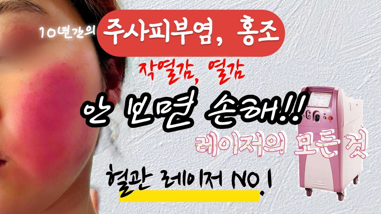 주사피부염 • 홍조 치료에 가장 효과있는 레이저 추천 | 열감, 작열감, 염증, 딸기코 | 혈관레이저, 브이빔퍼펙타, IPL, Co2 | 재생크림 후기 | 민감성피부, 장벽