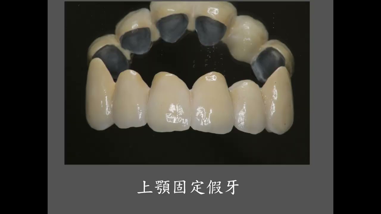 固定假牙合併局部活動假牙 蛀牙 及缺牙 上顎