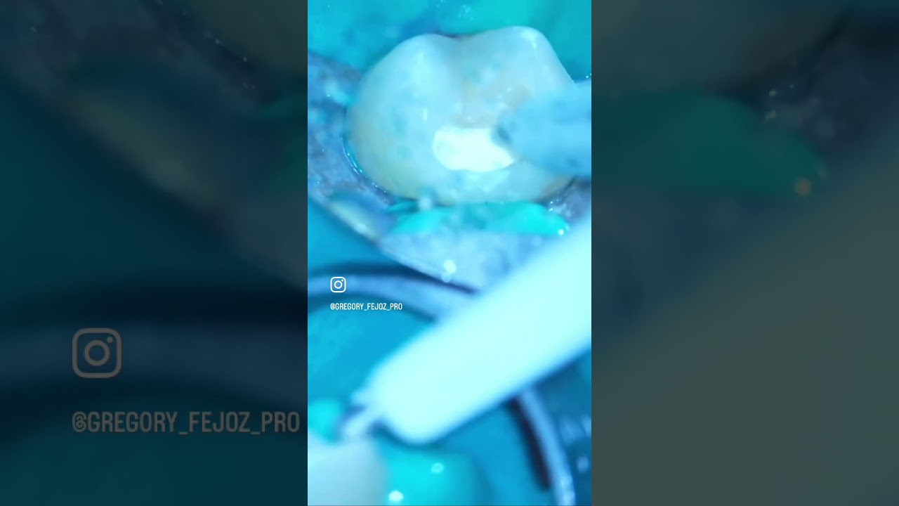 Pulpotomie Totale Endolight Technique + Komet BioRepair