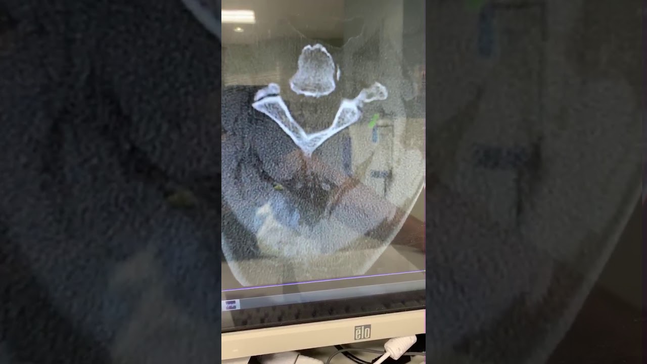 Dr Cyr Explaining a CT Scan of the Spine