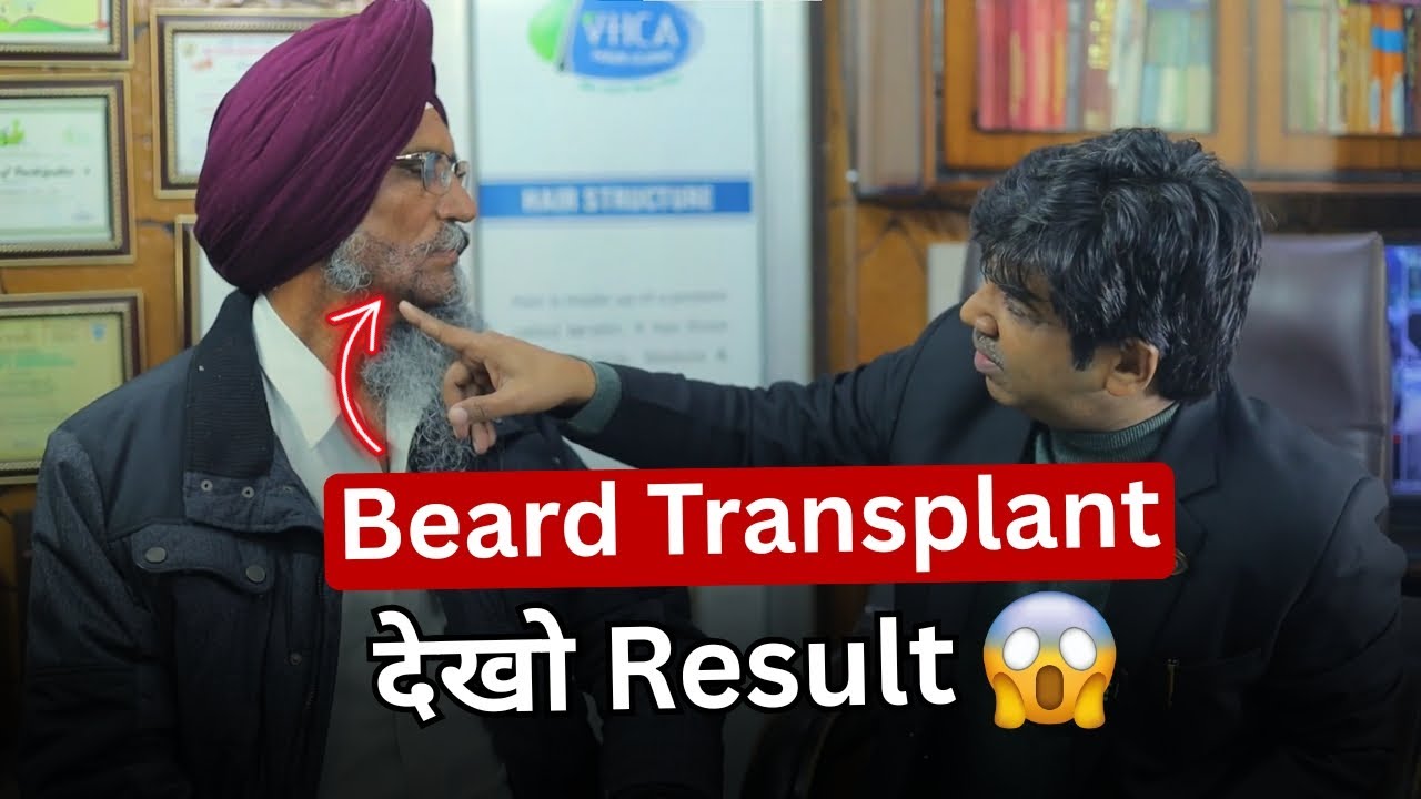 Scared of Beard Transplant?Watch This 65-Year-Old Patients Experience|Beard Transplant Success Story