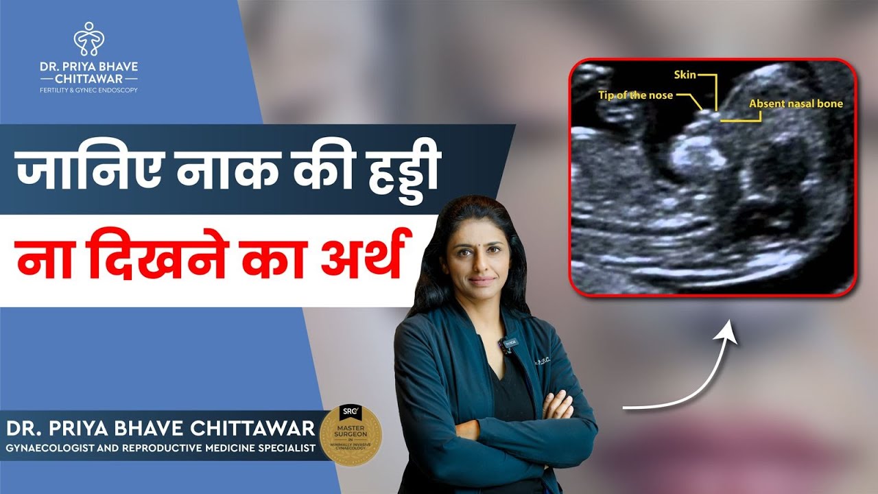 Absent Nasal Bone By Dr. Priya Bhave Chittawar