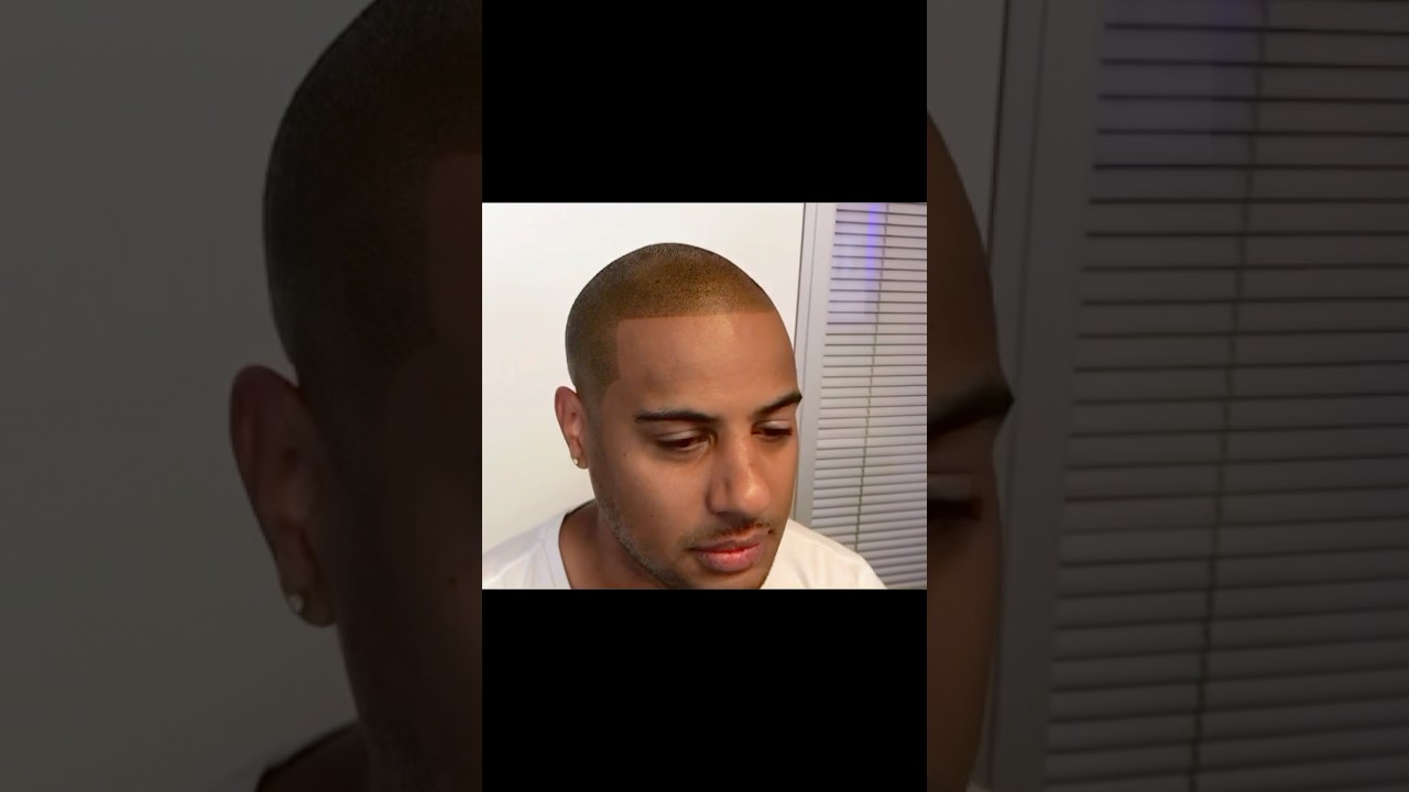 Nooit meer kaal! #haarlijn #haartattoo #kaalheid #alopecia #alopecianederland #dunhaar #fue