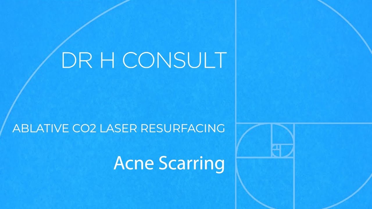 ABLATIVE CO2 LASER RESURFACING | ACNE SCARRING | Dr H Consult