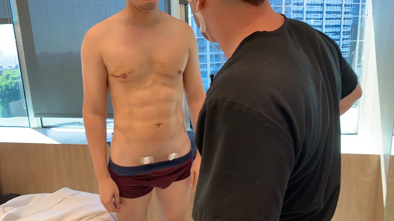 HD Liposuction Male Patient Follow-Up | West Hollywood, CA | Dr. Jason Emer