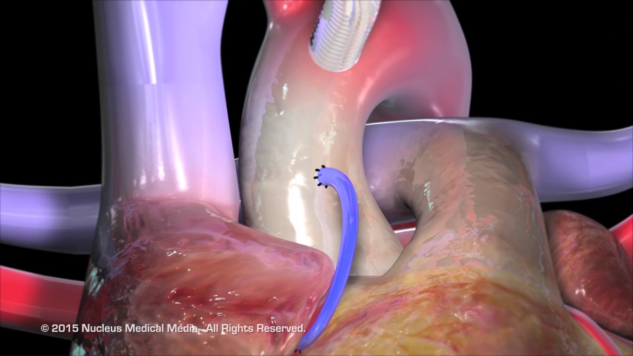 Coronary Artery Bypass Grafting (CABG)