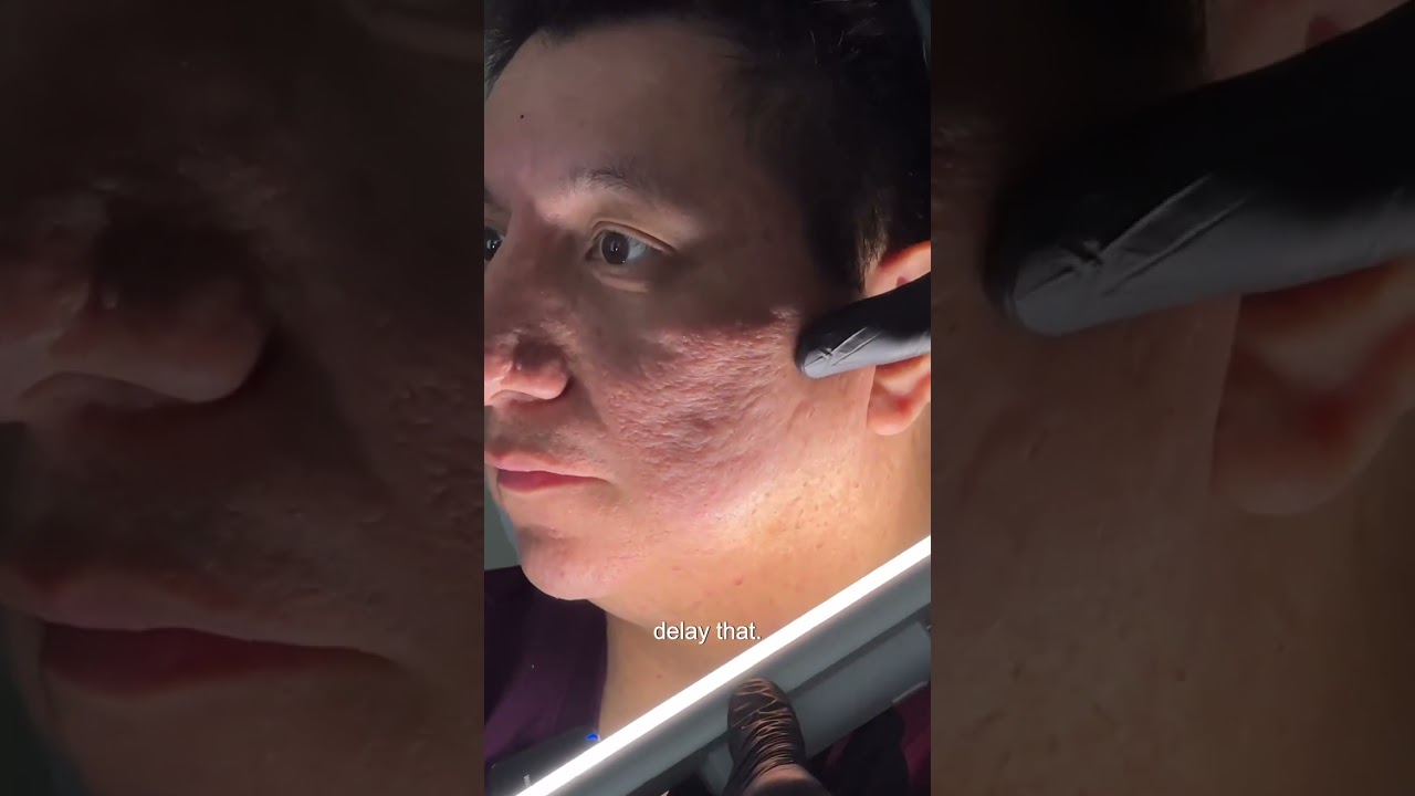 How Oil Production Affects Acne Scar Results