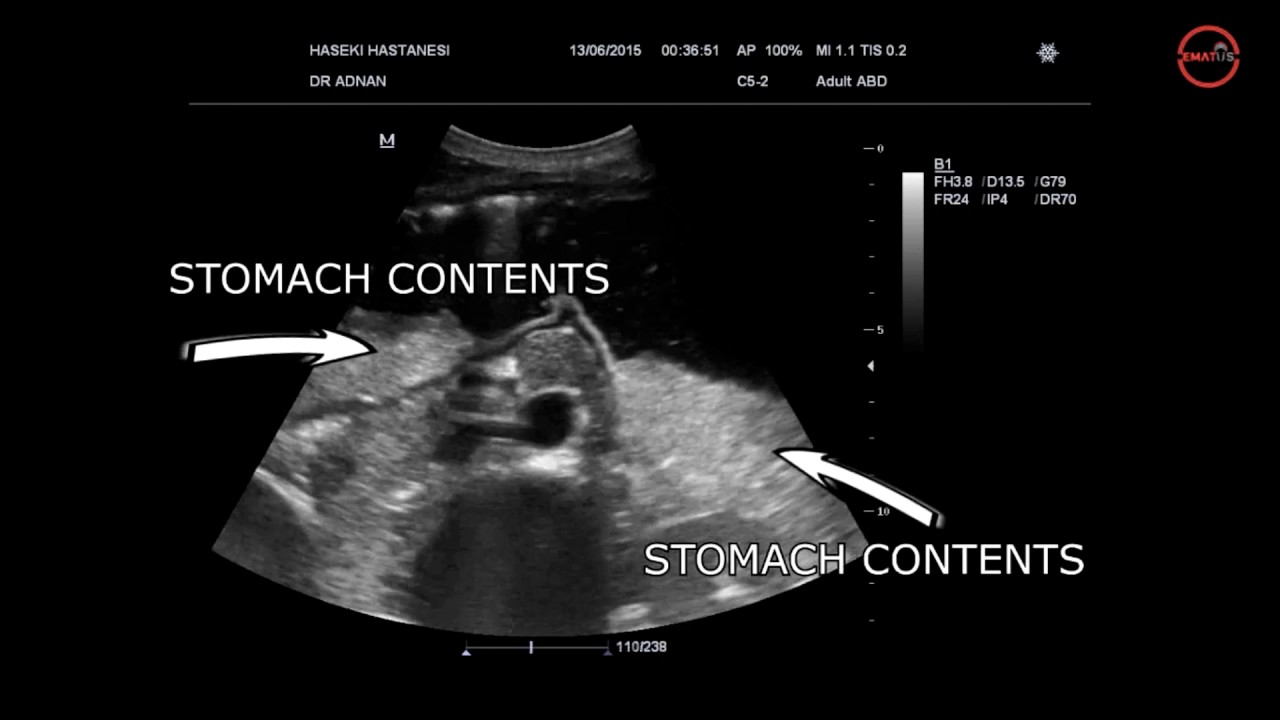 Gastrointestinal Perforation - Adnan YAMANOGLU, MD