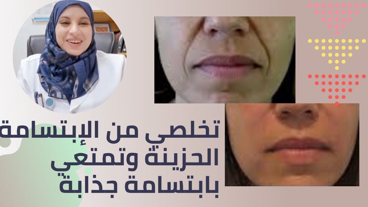 تخلصي من خطوط الفم او خطوط الابتسامة او الابتسامة الحزينة
