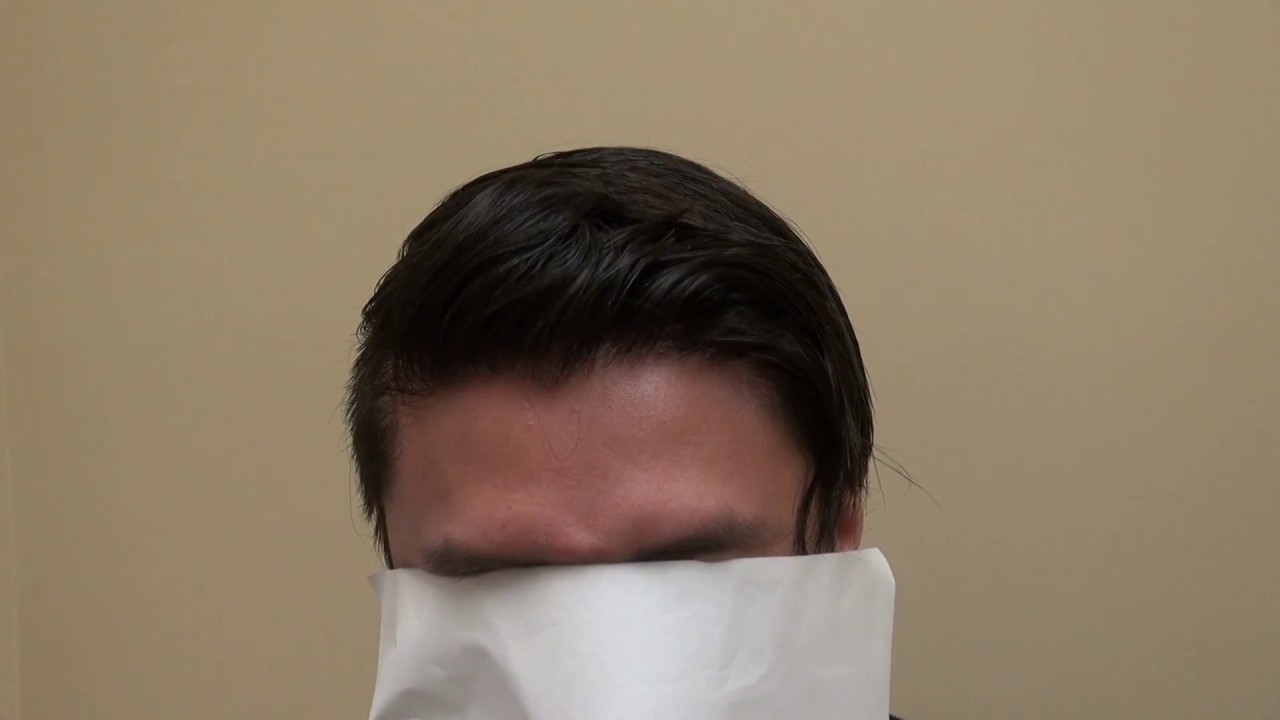 FUE Hair Transplant Surgery Result After Dr. Diep Repaired Hair Plugs Bad Hair Angle & Hairline