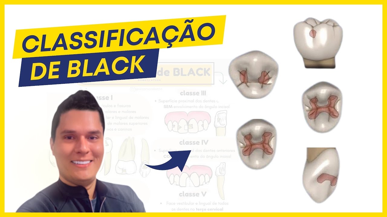 Classificações de Black | Dentística (Guia Completo).