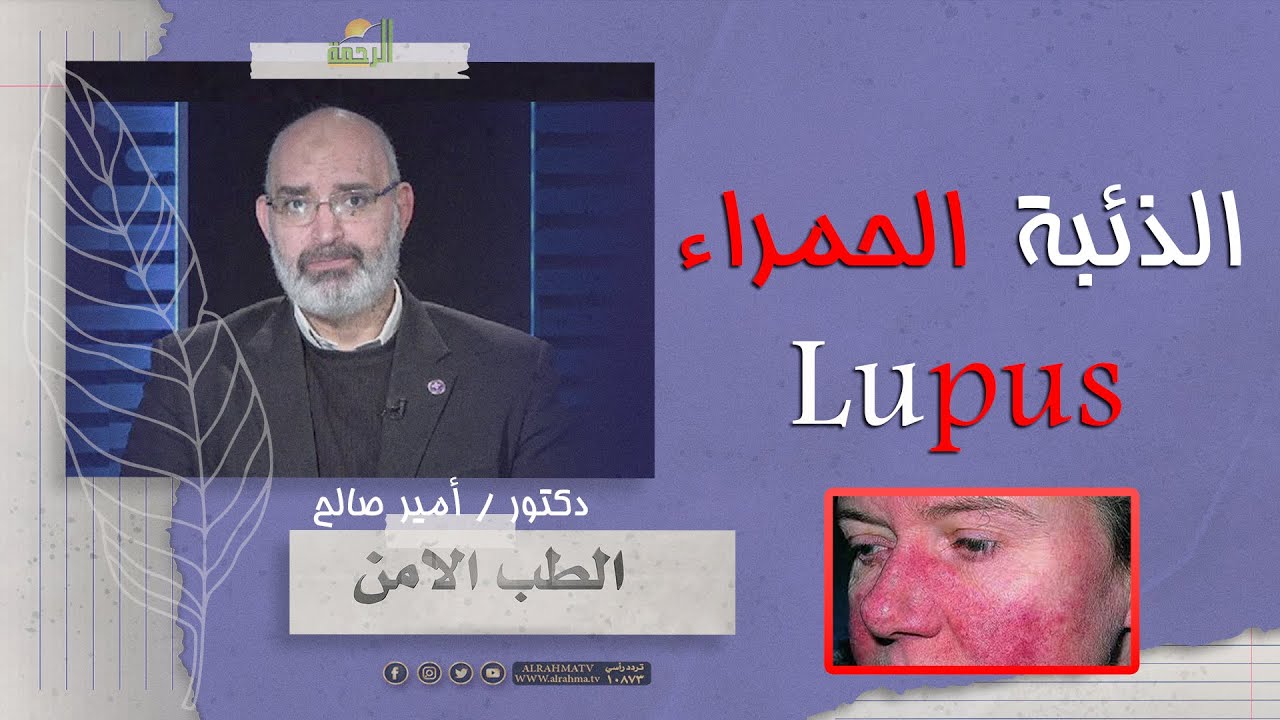 الذئبة الحمراء || الطب الأمن || دكتور أمير صالح