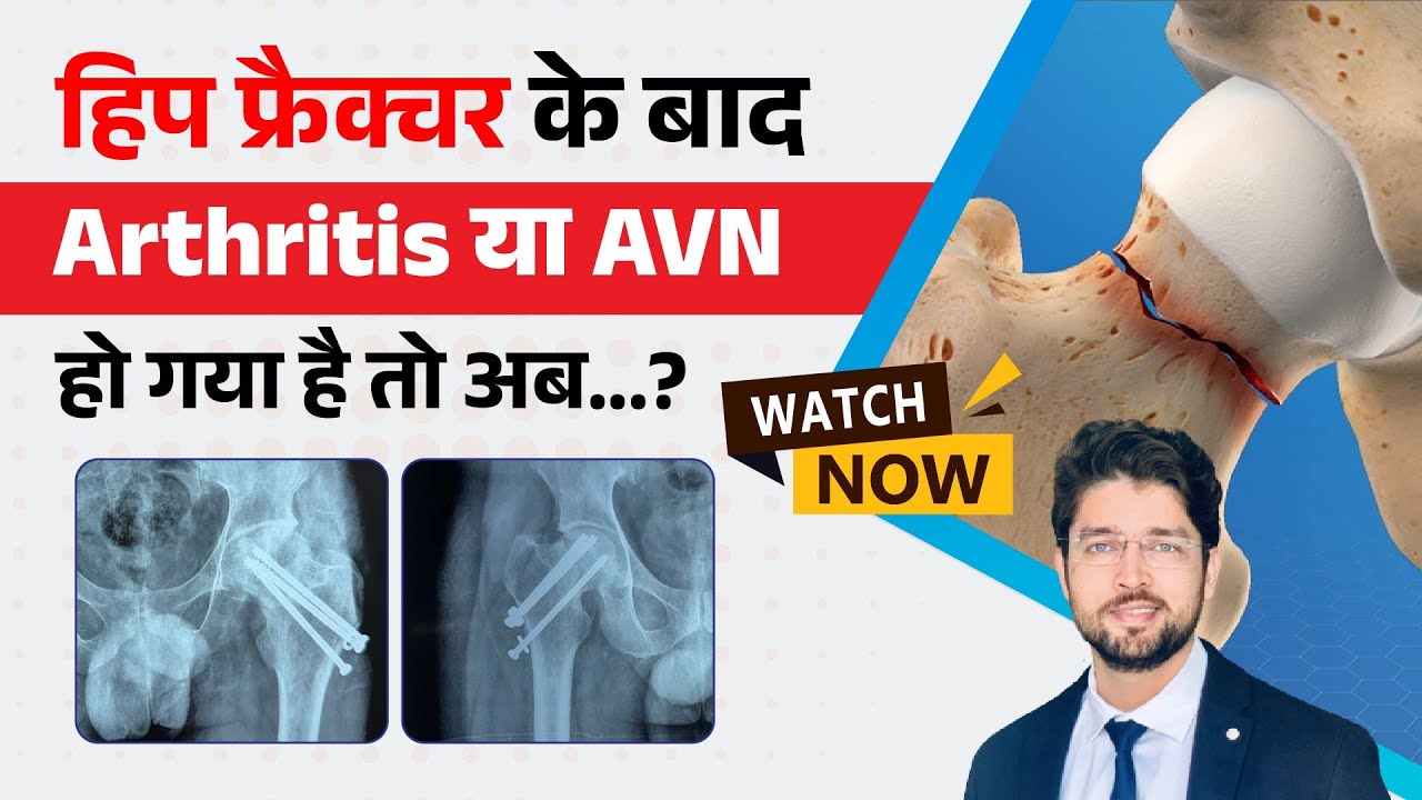 Arthritis/AVN After Hip Fracture Screw or Plate | Hip Replacement By MIS Bikini DAA In Delhi-NCR