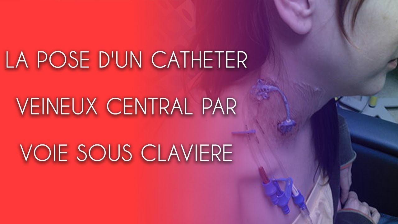 LA POSE D'UN CATHETER VEINEUX CENTRAL PAR VOIE SOUS CLAVIERE