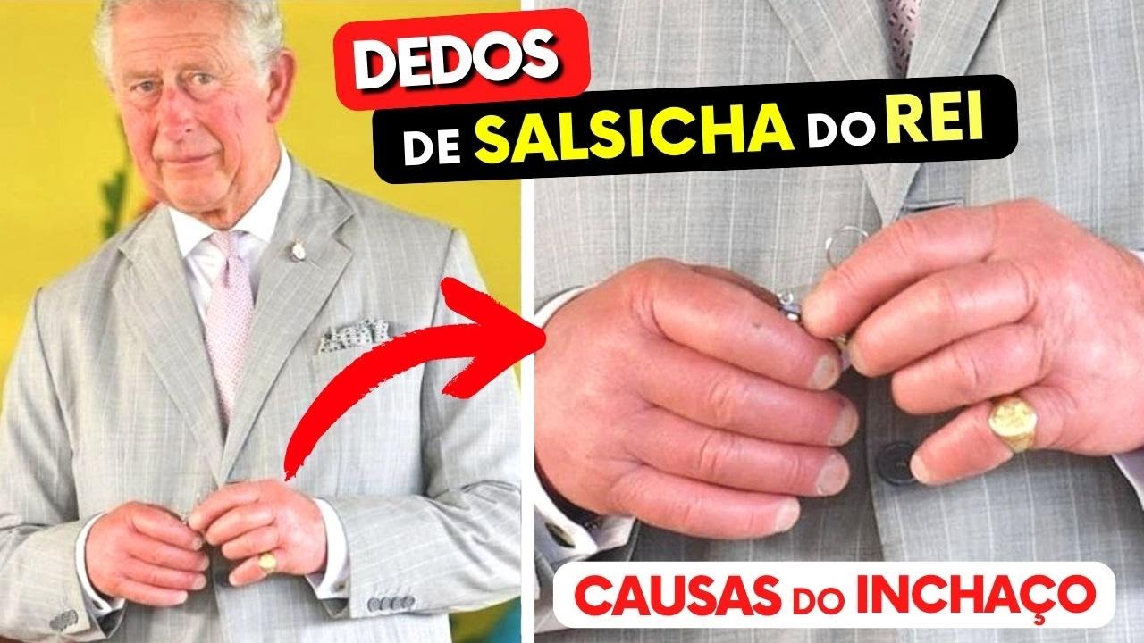 MÃOS INCHADAS do Rei! CAUSAS e o O QUE FAZER (Mãos de Salsicha!)