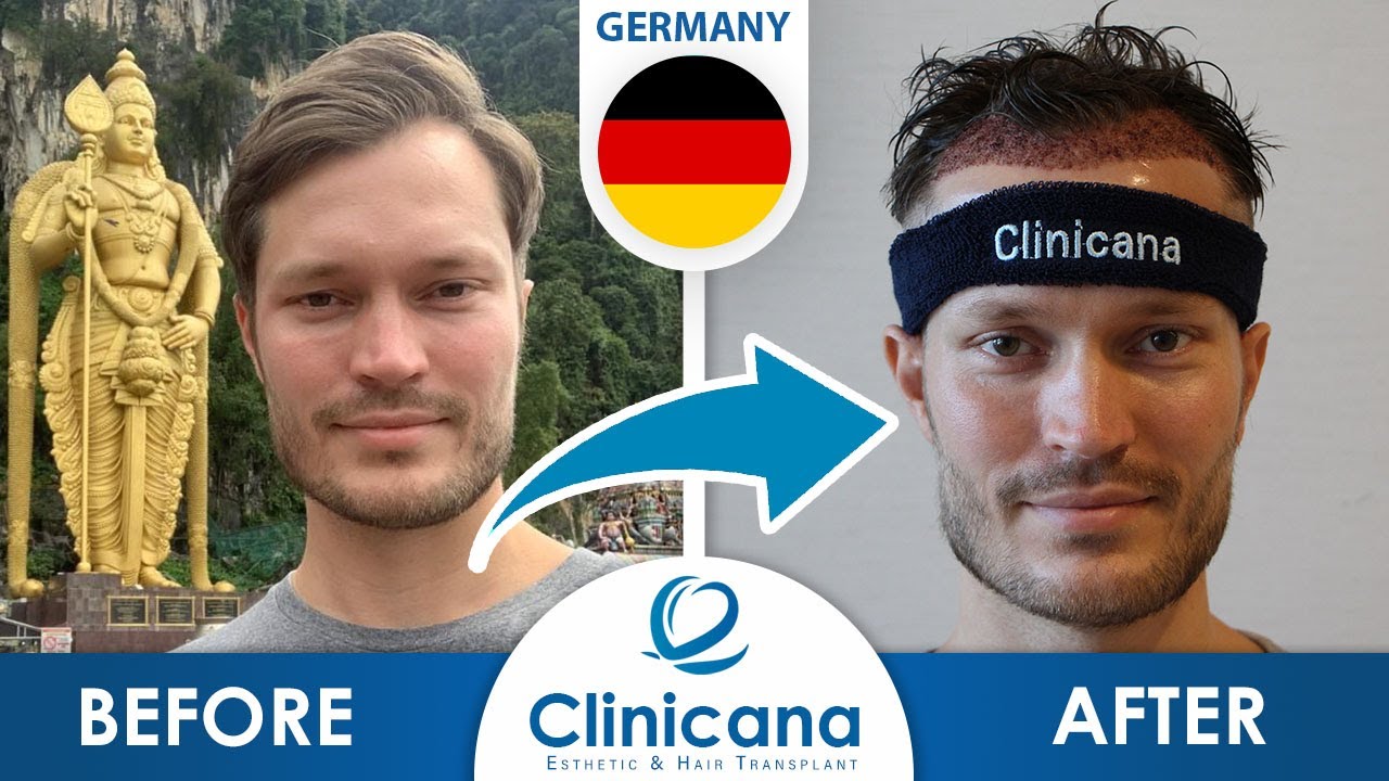 Mika's Hair Transplant Journey in Istanbul Turkey | Clinicana