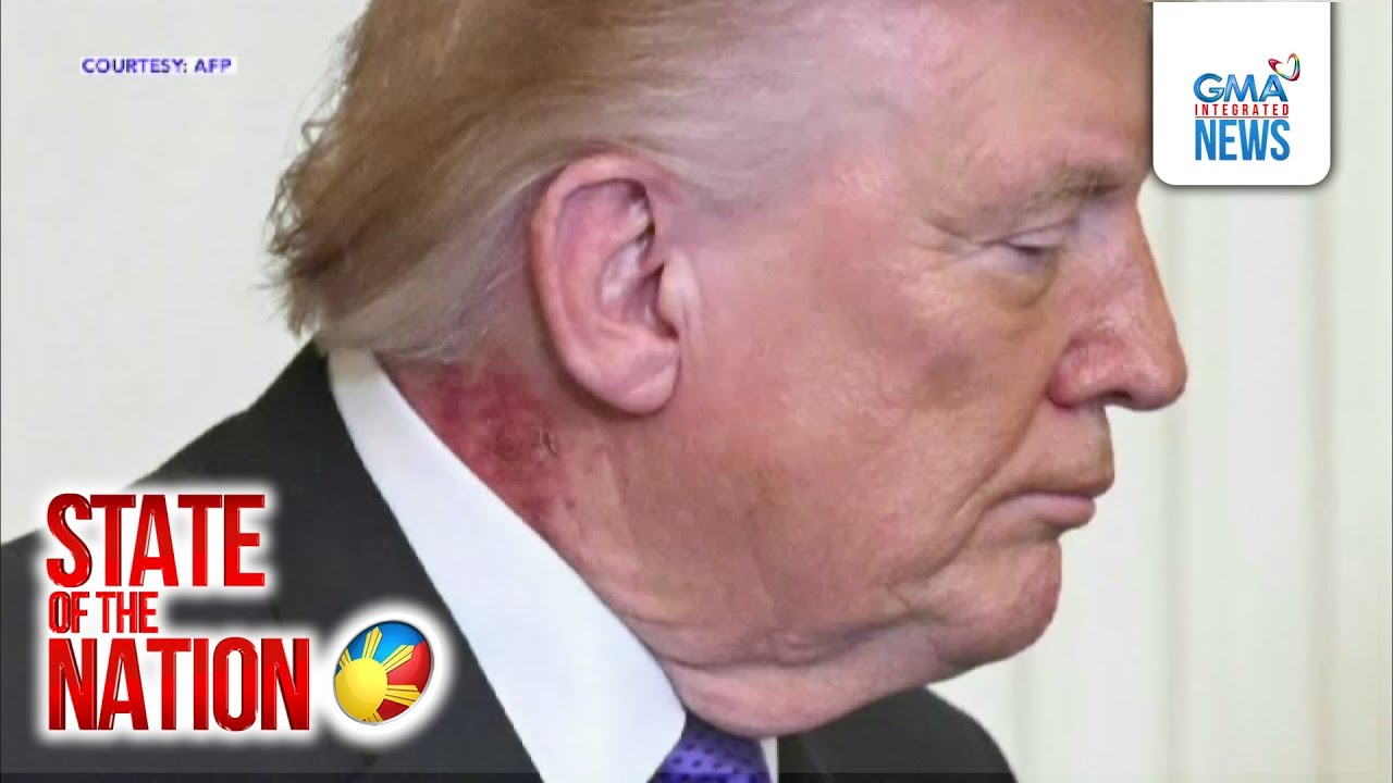 Mapulang rash sa leeg ni Trump, dahil sa ipinapahid na 