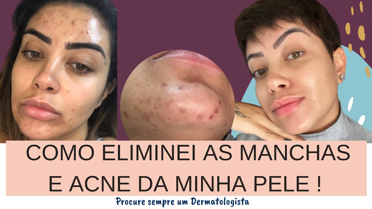 COMO ELIMINEI AS MANCHAS E ACNE DA MINHA PELE !