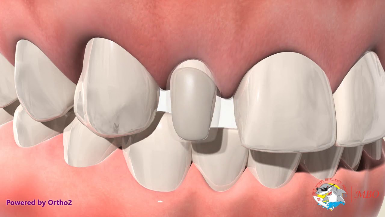 Peg Laterals braces build up