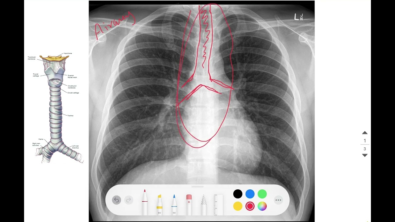 شرح كيفية قراءة أشعة الـchest x-ray
