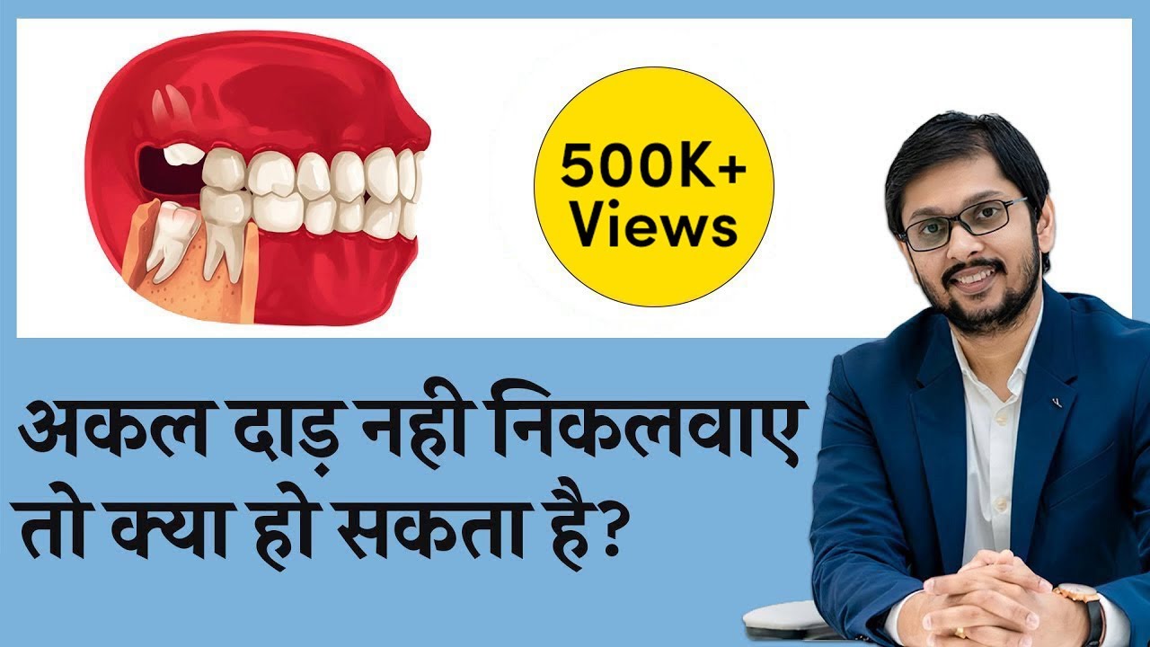 अक्कल दाढ निकलवाए या नहीं ? अक्कल दाढ़ दर्द  का इलाज | Wisdom Teeth Removal | by Dr Ankit SERAPHIC