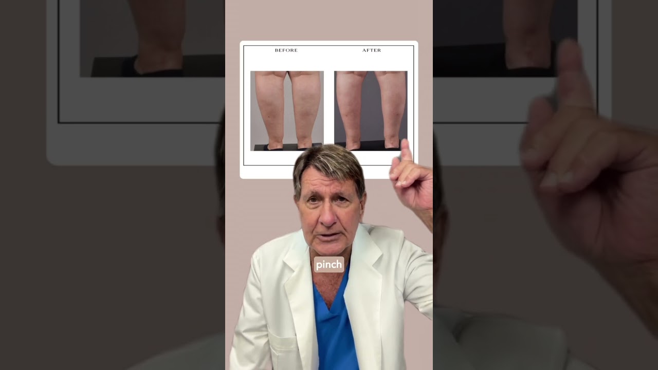 Calves and Ankles Liposuction Before and After