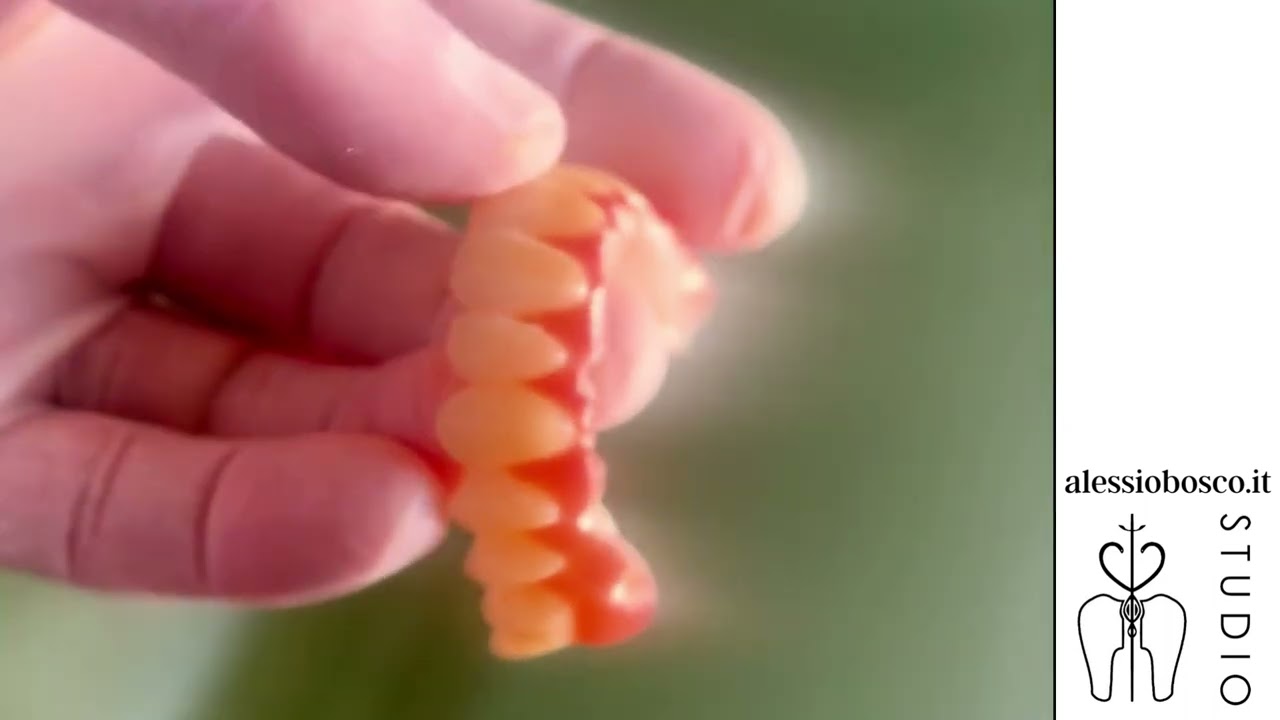 Protesi a quattro impianti