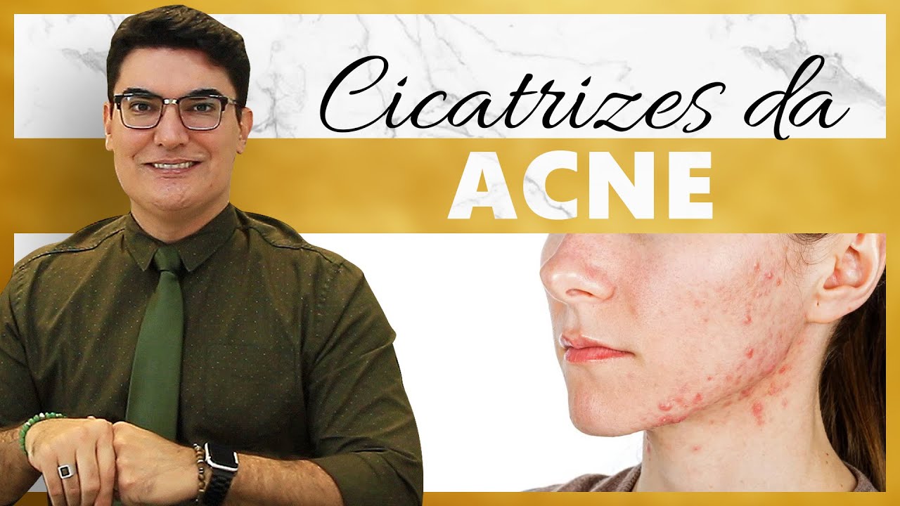 Cicatrizes de Acne