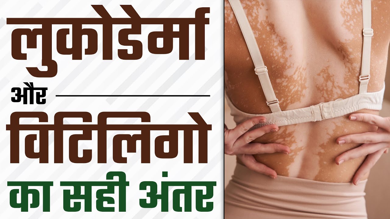 जानिये लुकोडेर्मा और विटिलिगो का सही अंतर | Difference Between Leucoderma and Vitiligo