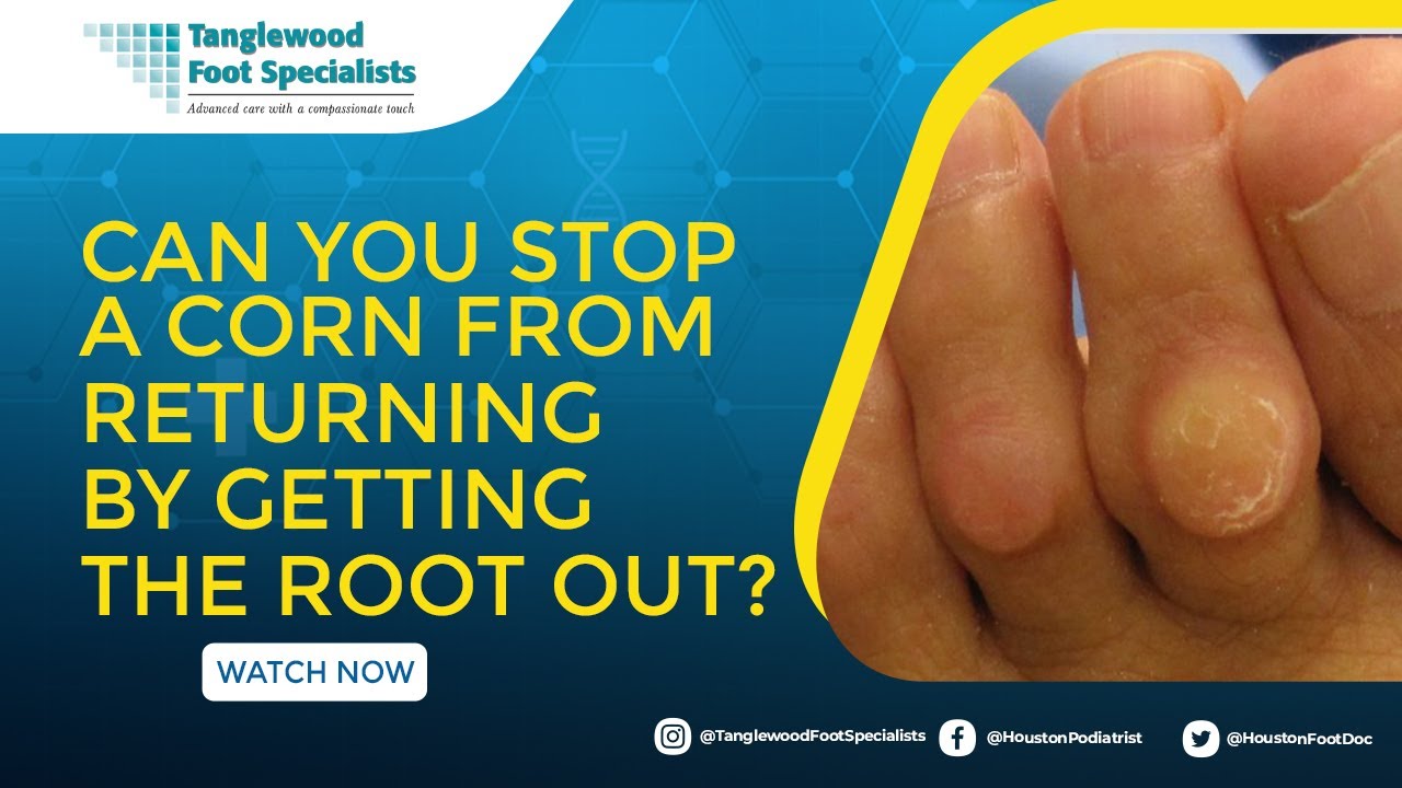 Can You Stop a Corn from Returning By Getting the Root Out?