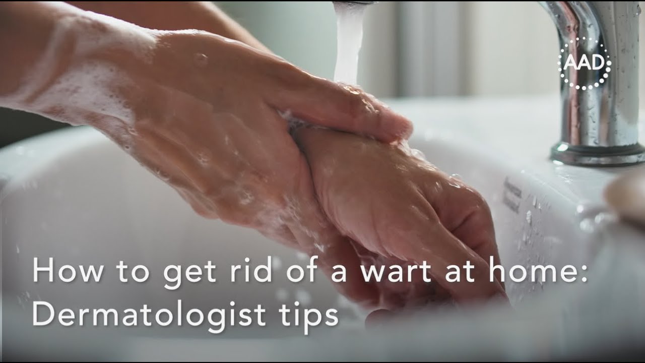 How to get rid of a wart at home: Dermatologist tips