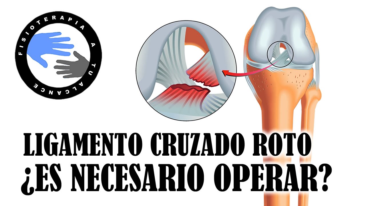 Rotura de ligamentos cruzados, ¿es necesaria la operacion?