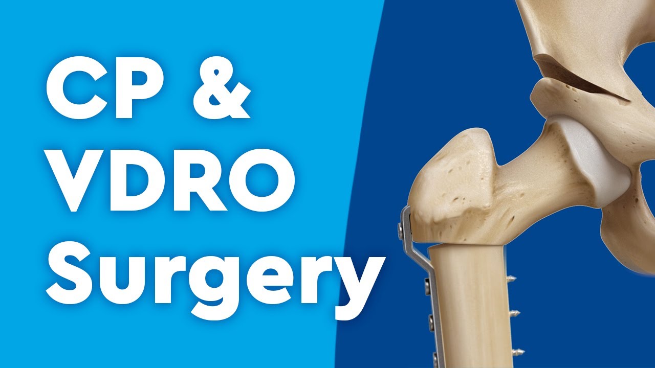 About Cerebral Palsy and VDRO Surgery to Improve Mobility