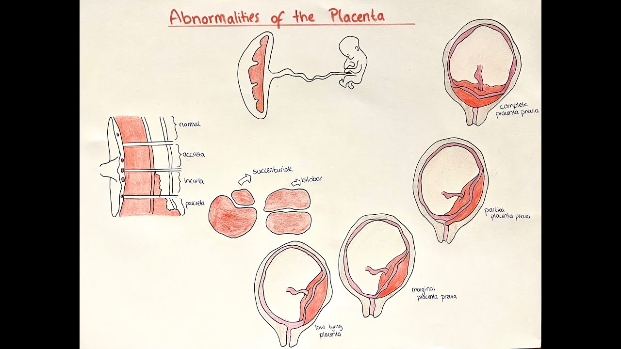 Placental Abnormalities - accreta, previa, abruption, multi lobar