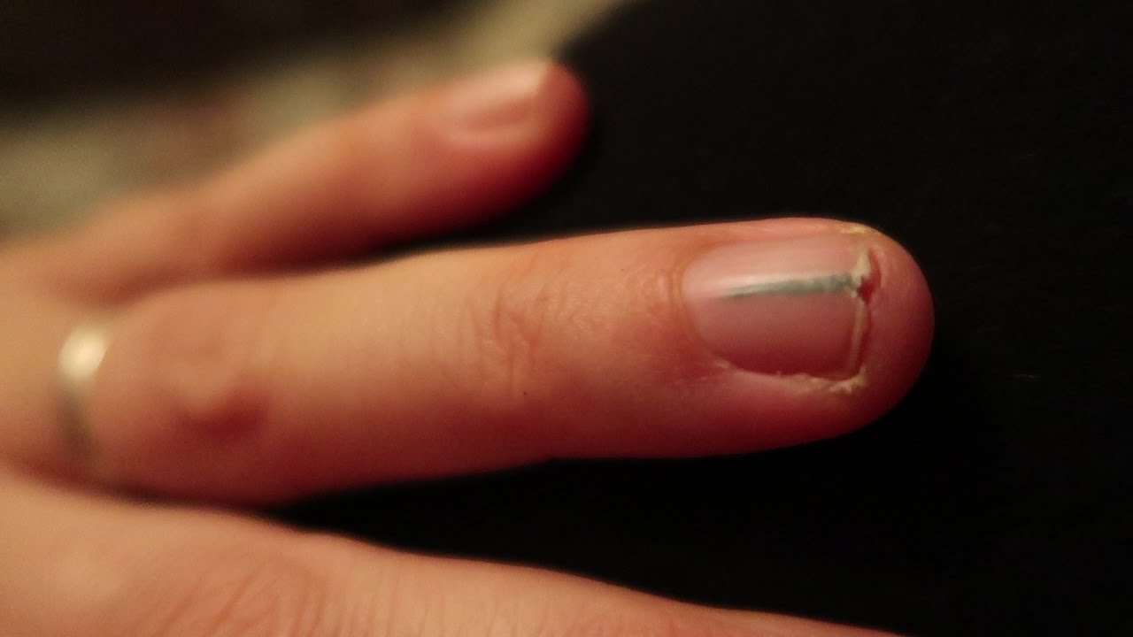 Can I Get This GIANT Splinter From Under My Fingernail? !!!!!