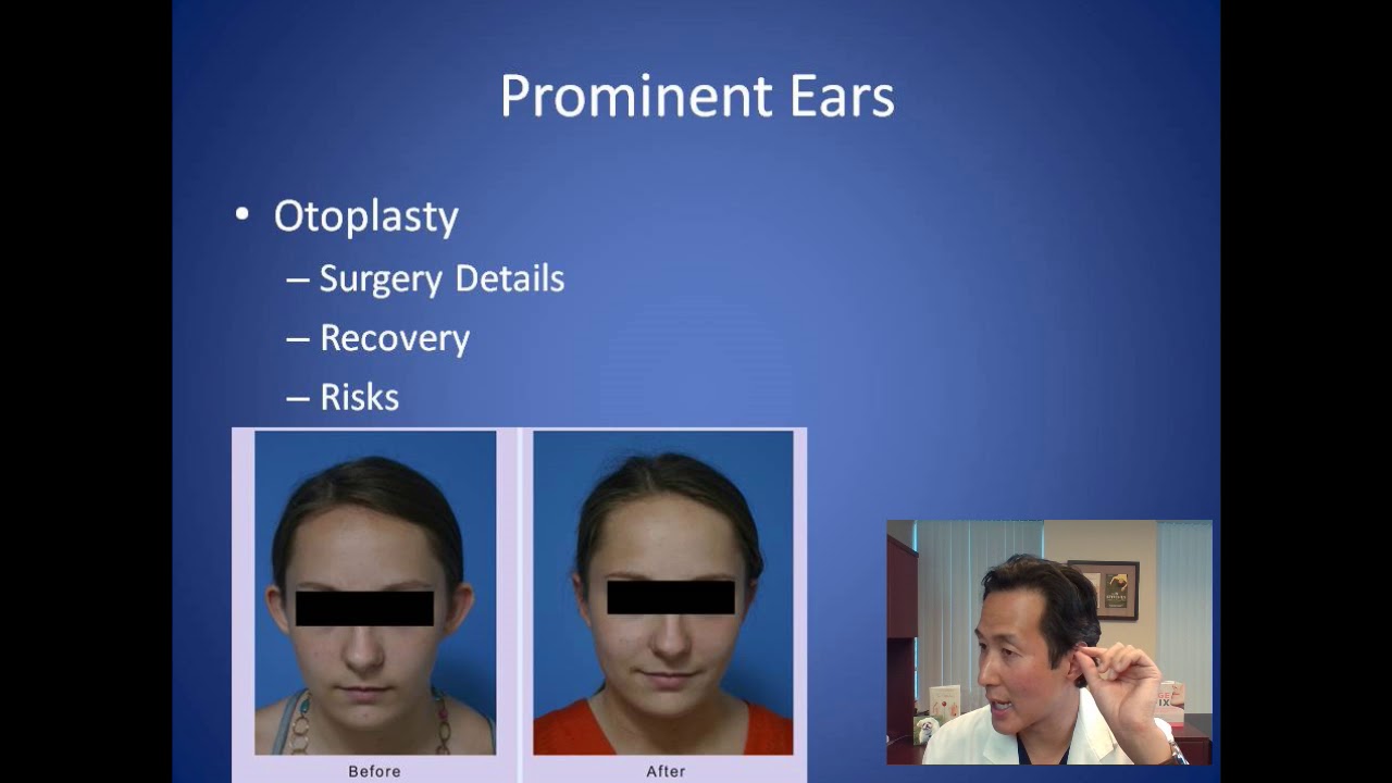 How Can I Fix Ears that Stick Out - Otoplasty Consultation - Dr. Anthony Youn