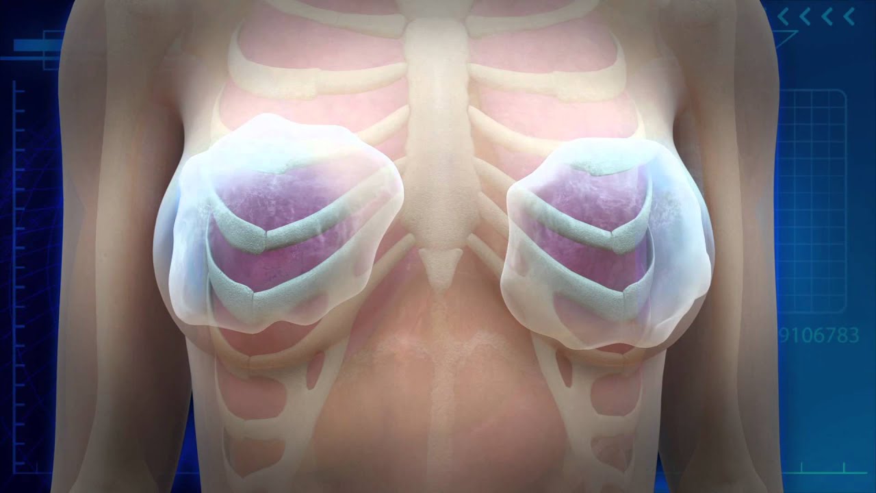 PIP breast implants 16 times more likely to rupture: British study