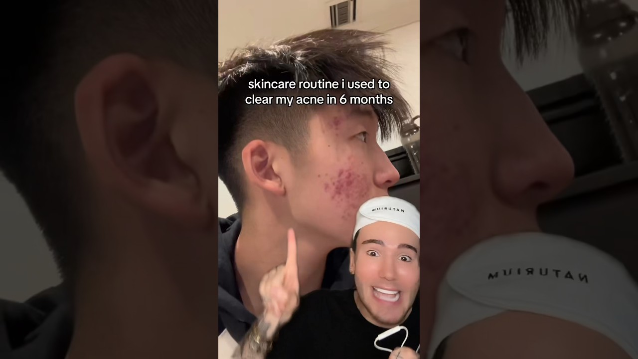 VIRAL SKINCARE ROUTINE FOR ACNE😱 (follow for more💗) @jiustinchung #acne #skincare #skin #beauty