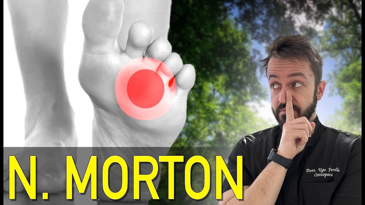 Neuroma di Morton: guida completa ed esercizi per eliminare il dolore