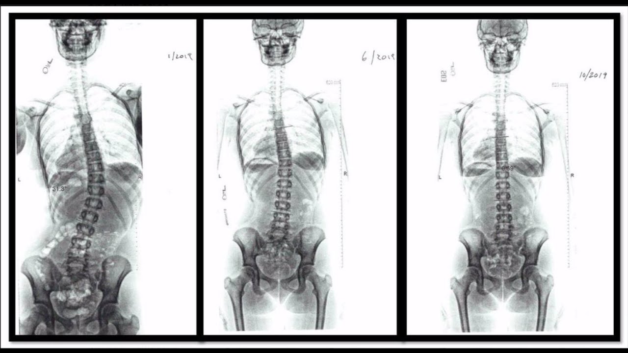 What are Schroth Exercises for Scoliosis from a Certified Therapist: Scoliosis Education & Treatment