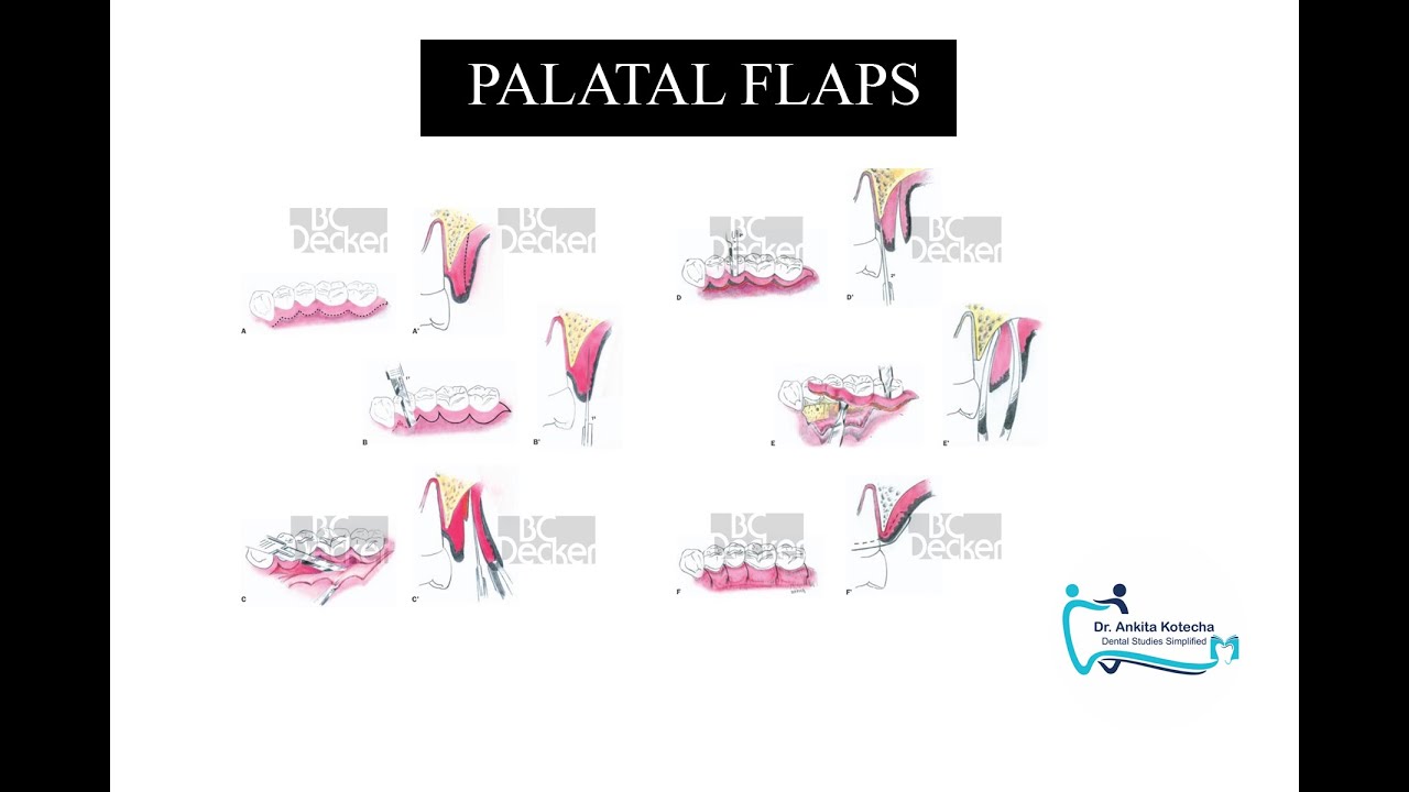 PALATAL FLAPS| PARTIAL THICKNESS PALATAL FLAPS | DR. ANKITA KOTECHA | DENTAL STUDIES SIMPLIFIED