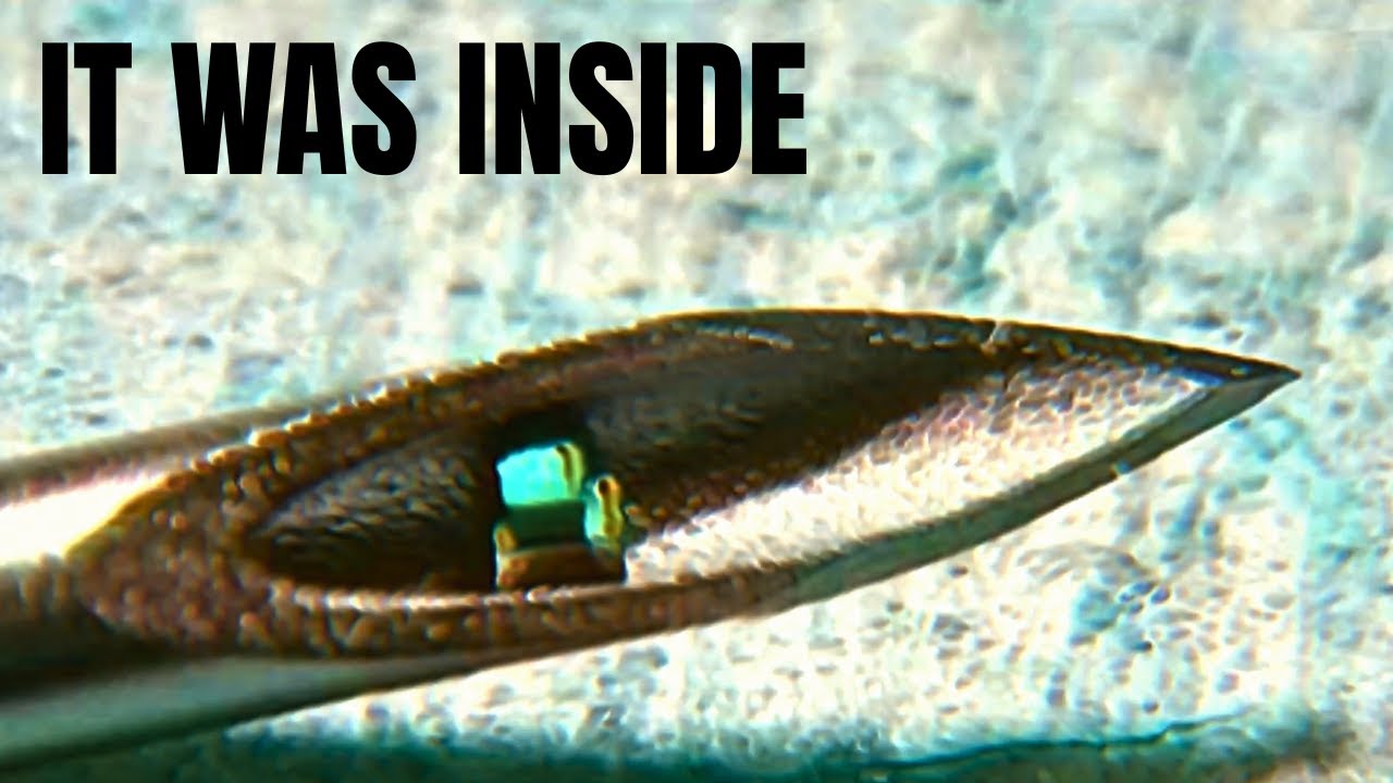 Doctors Keep Finding These in People&hellip; Are They Alien?